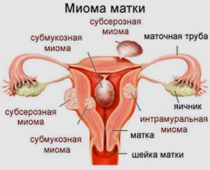 Миома матки симптомы и признаки боль в правом боку под ребрами спереди у женщины причины и лечение