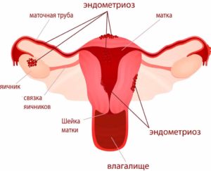 Миома и эндометриоз