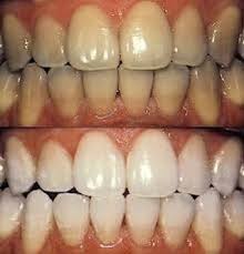 Профессиональная чистка зубов - как это происходит?