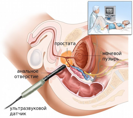 Ecografia prostata adenoma, Prosztatagyulladást okozó betegségek